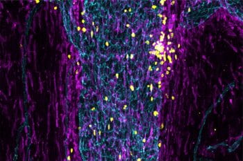 Immune cells (yellow and purple) fill a sinus (teal) in the outer layer of the meninges, the tissue that surrounds the brain and spinal cord. Researchers at Washington University School of Medicine in St. Louis have found that immune cells stationed in such sinuses monitor the brain and initiate an immune response if they detect a problem.