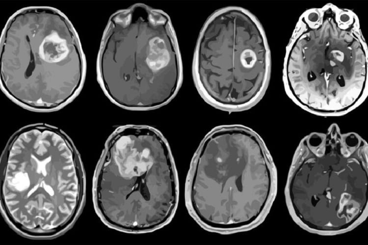 Pictured are MRI scans of eight patients with glioblastoma, an aggressive brain tumor. A new study led by Washington University School of Medicine in St. Louis has mapped out detailed molecular and genetic schematics of these tumors, opening the door to potential improved therapies. (Image: Albert H. Kim)